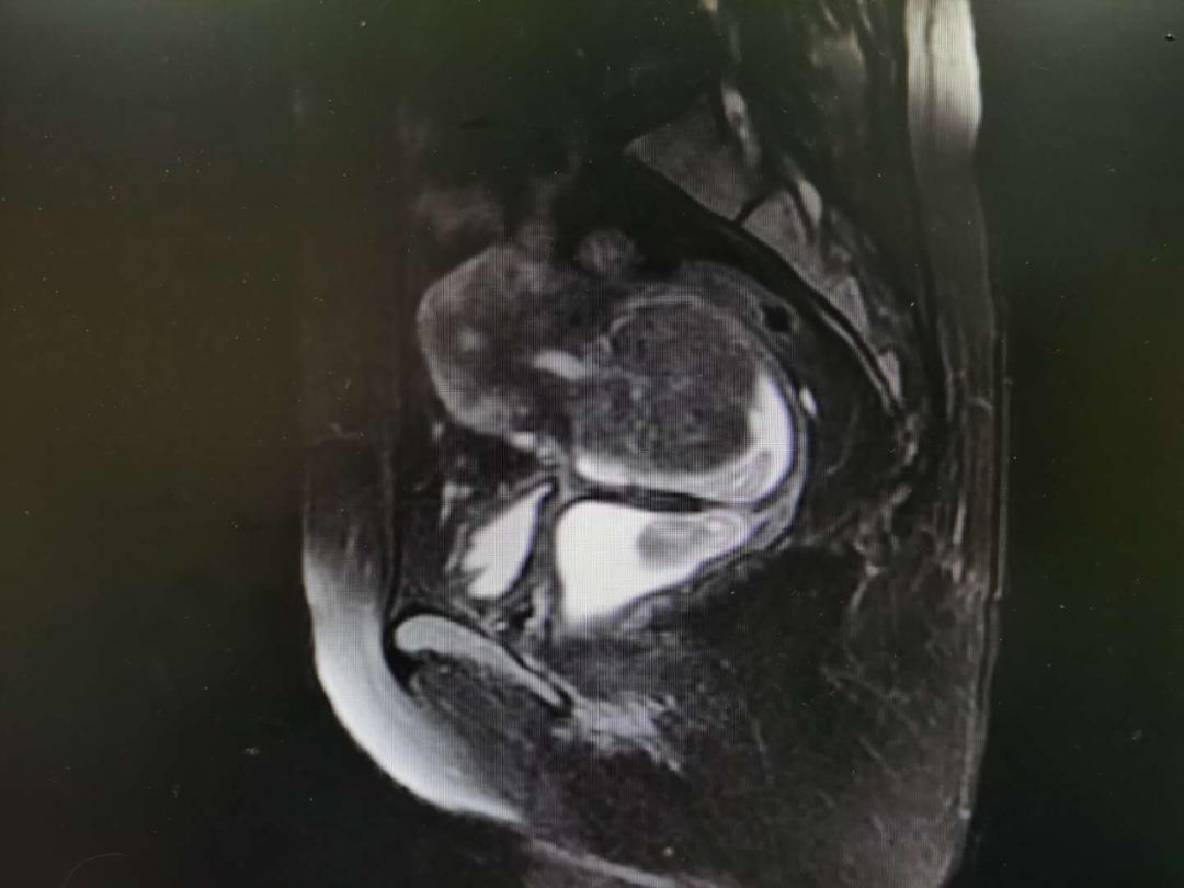 围绝经期综合征能治好吗,围绝经期综合征存在的护理问题有