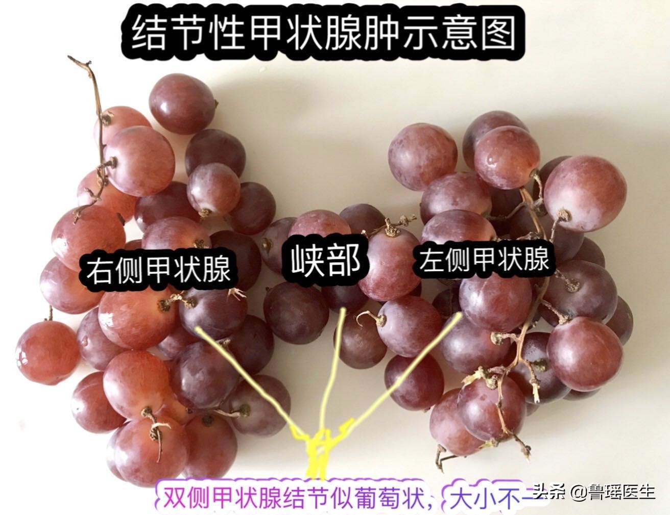 甲状腺结节从生长到发现要多久,甲状腺结节观察3个月会变大吗