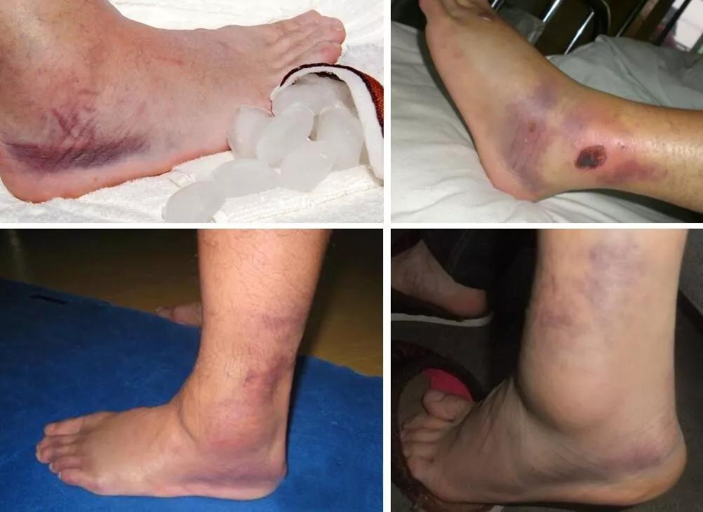 跑步最常见的十种伤痛及处理方法,跑步相关运动损伤综述