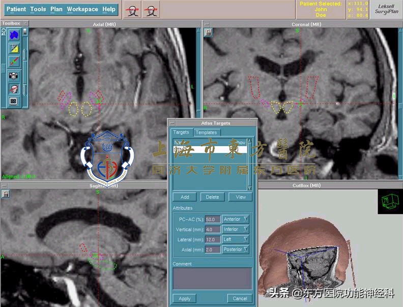 难治性精神病有必要外科手术吗,手术治疗精神病的成功率