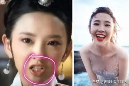 明星牙齿矫正前后对比,明星牙齿矫正都用的什么矫正方式