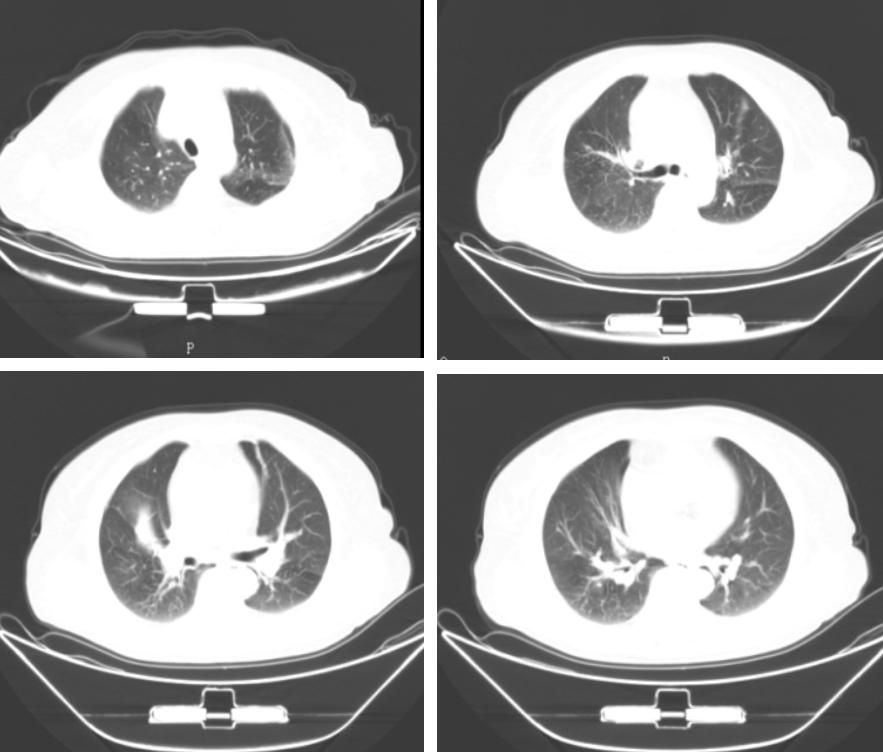 鍖荤敓鏃犳硶鍒ゆ柇缁撹妭鐥呰繕鏄粨鏍哥梾,鏈夎偤缁撴牳鐥呭彶鍗佸嚑骞存煡鍑鸿偤缁撹妭