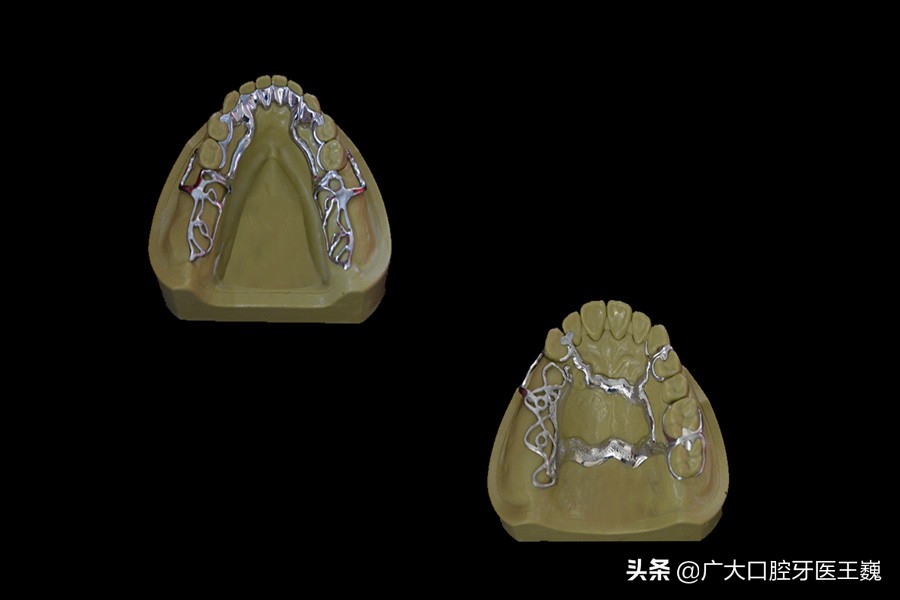 较好的活动义齿能用多久,目前最先进的活动义齿