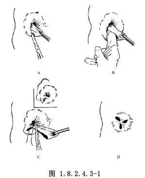 都说十人九痔痔疮能根治吗,十人九痔八不治