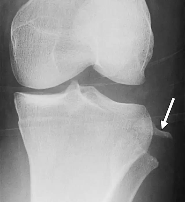 骨折处出现麻痹感,骨折跟精神状态有关