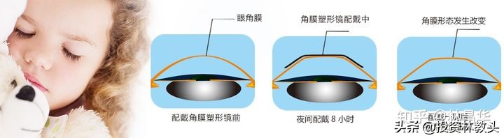 欧普康视效果怎么样,欧普康视真的有效吗