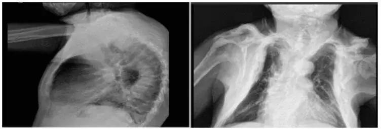 透析病人肌酐急速上升为什么,透析三次肌酐从1100降到500多