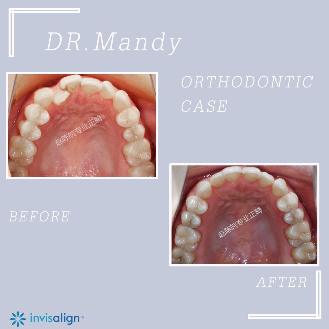 厦门牙齿矫正前后对比,牙齿矫正对脸型的改变有多大知乎