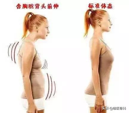 一招改善含胸驼背骨科医生,骨科医院专门矫正驼背
