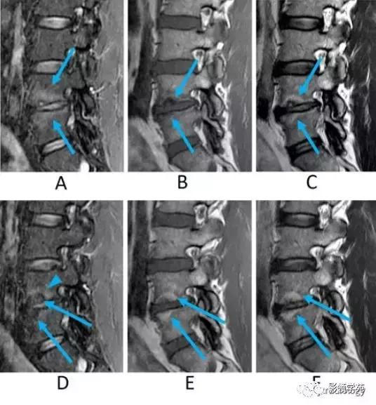 9种椎体和椎旁信号增高的非肿瘤性病变