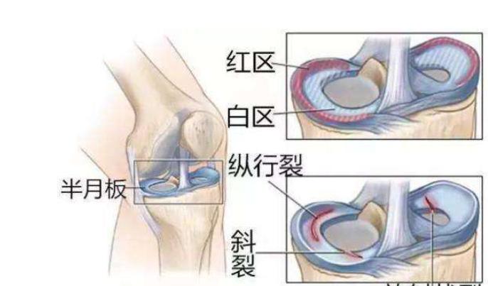 关节镜半月板撕裂手术几天能出院,关节镜半月板修复术后弯曲难