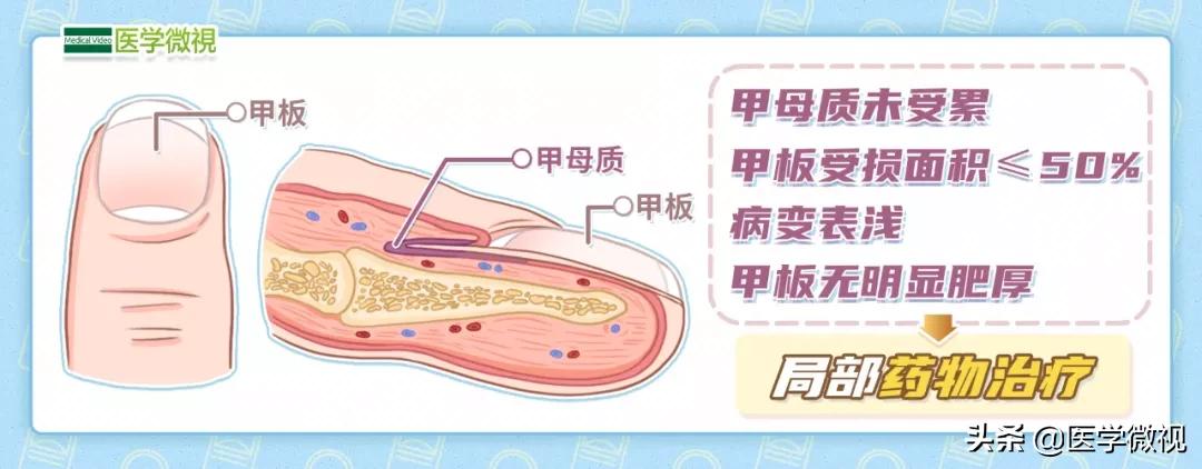 灰指甲治了半年也没治好？可能不是药的问题