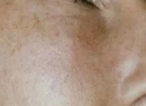 光子嫩肤唤醒肌肤活力重塑娇颜,光子嫩肤让你焕颜一新