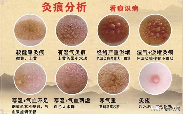 艾灸以后人没精神,艾灸完了人为什么很累