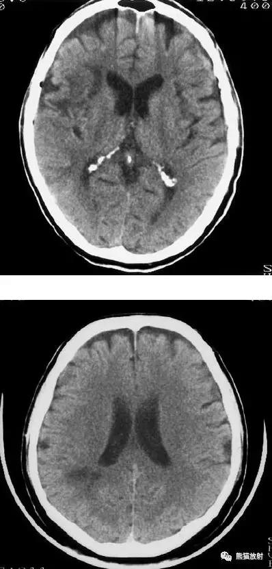 脑梗死丨演变、血供区域分布、CT表现