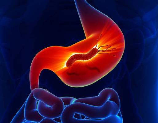 胃幽门螺旋杆菌感染是怎么回事,关于胃幽门螺旋杆菌的知识和治疗