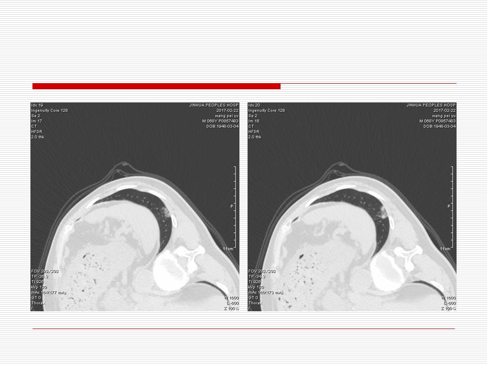 像炎症的肺癌能治好吗,医生说可能是肺癌也可能是炎症