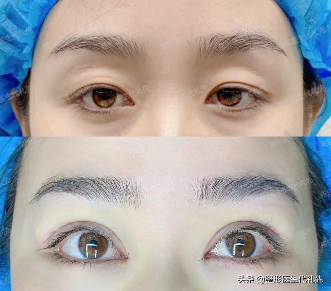 聊一聊眼睛手术,双眼皮怎么选看完你就知道了