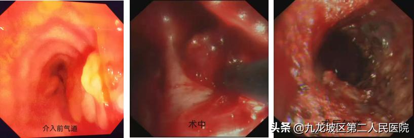 你知道支气管淀粉样变吗？82岁大爷在手术台上竖起了大拇指