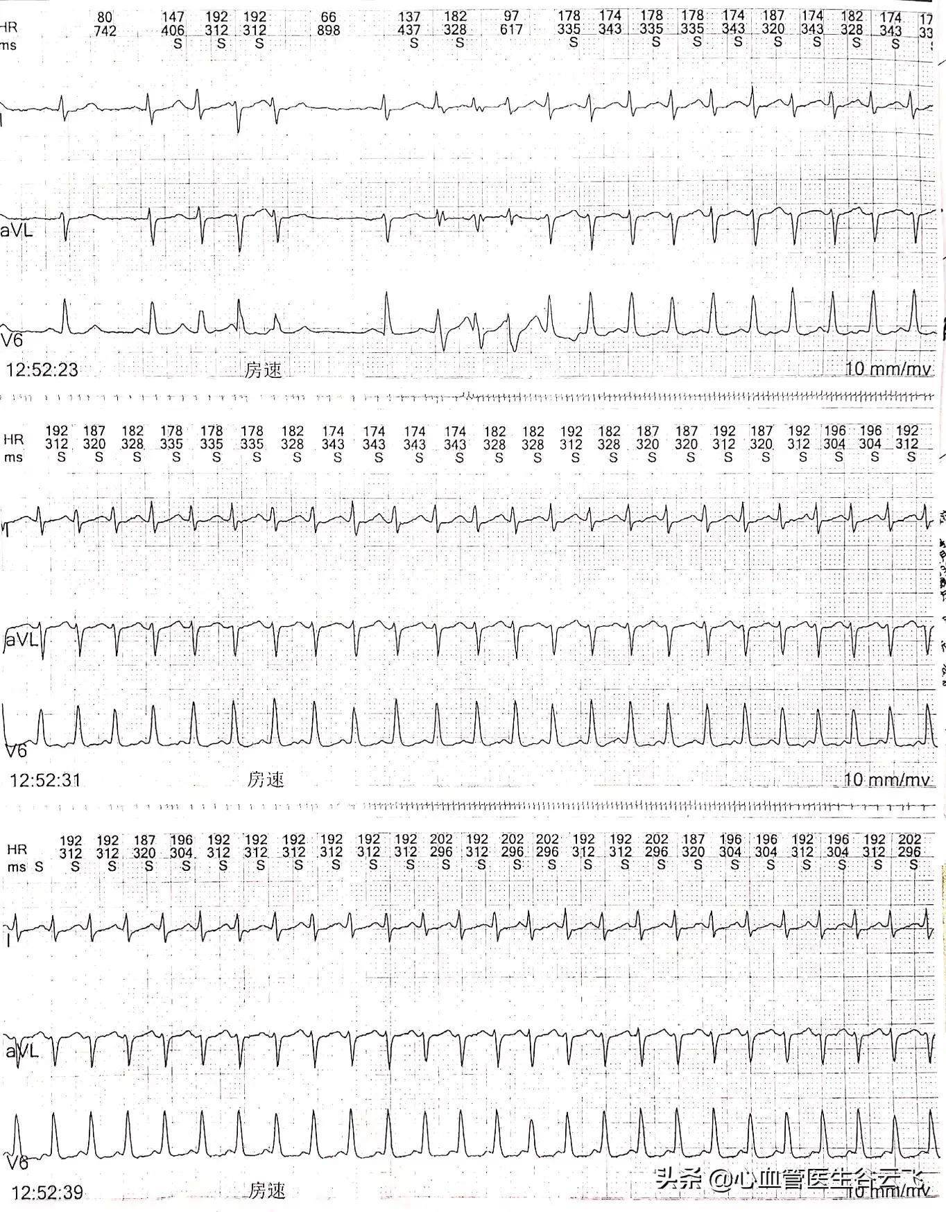 心律失常频发房性期前收缩,心律失常门诊故事