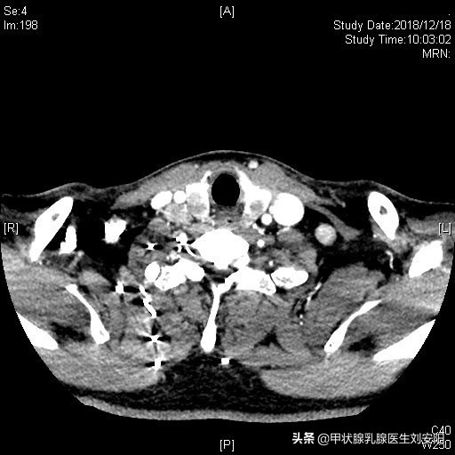 体检查出cea偏高的人多吗,体检cea指标升高是什么原因