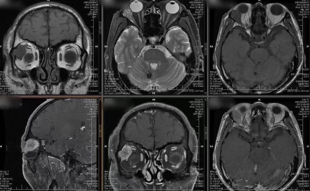 眼眶修复与重建,泪腺突出眼眶怎么治疗