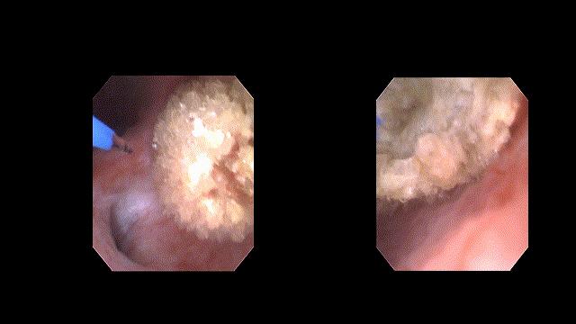 输尿管电子软镜,江苏一次性输尿管软镜