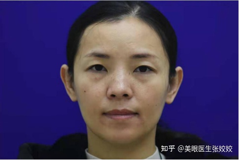 割双眼皮会影响运势吗,40岁割双眼皮效果图