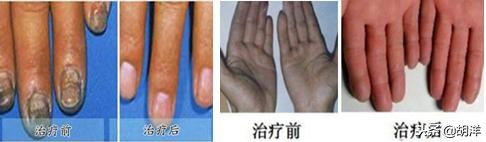 不输肺癌？得了间质性肺病真的只能活两三年吗？专家讲出大实话！