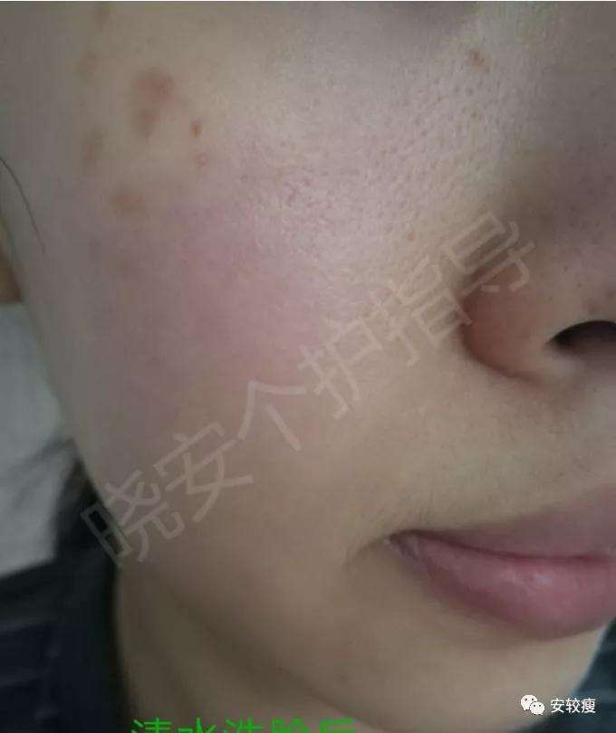 皮炎疹子干燥泛红,秋冬皮肤泛红发烫