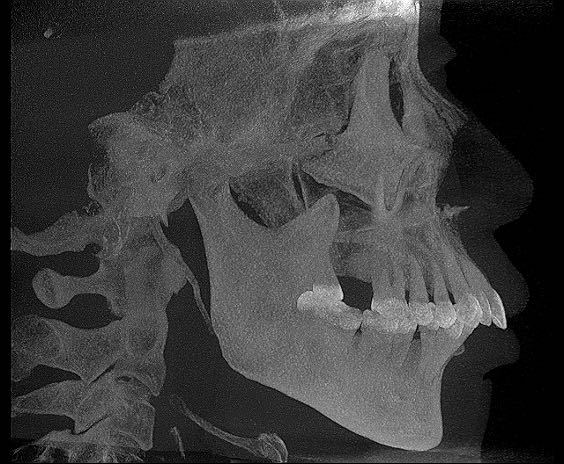 杨磊正畸医生,牙周病牙龈萎缩正畸案例