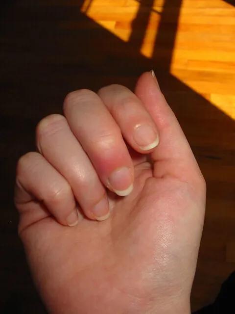 困扰小岳岳的甲沟炎,有没有好的治疗方法?医生给相声粉丝的科普