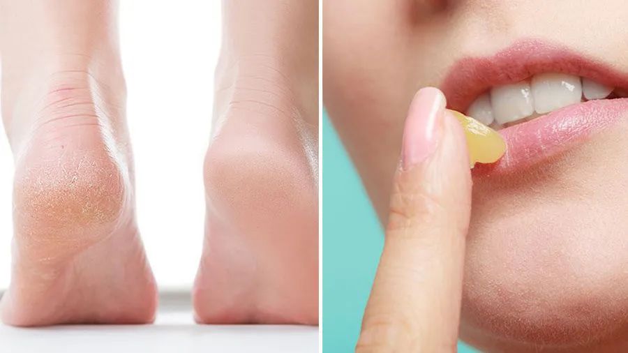 专家说痔疮膏治黑眼圈,网络流行的痔疮膏去黑眼圈