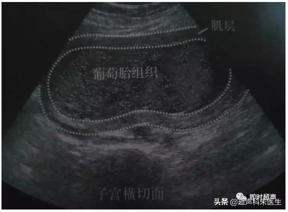 妇科常见疾病的超声诊断视频,超声常见疾病