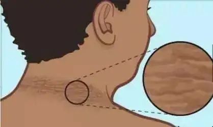 脖子上有类似黑泥,脖子上都是黑色老泥要怎么去除