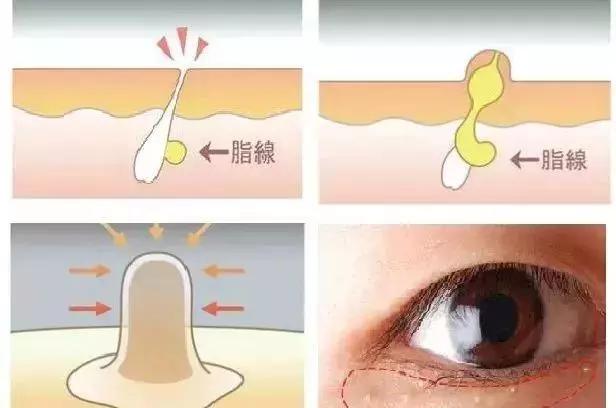 脂肪粒怎么用针挑出的,脂肪粒多久可以用针挑出来