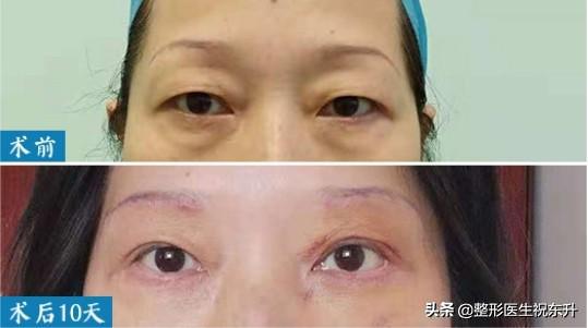 眼皮下垂做全切好还是做提眉好呢,做完提眉两年以后眼皮还会下垂吗