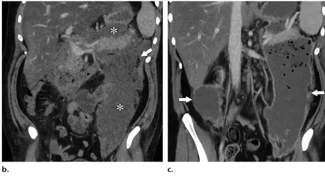 急性胰腺炎影像检查首选,急性坏死胰腺炎影像