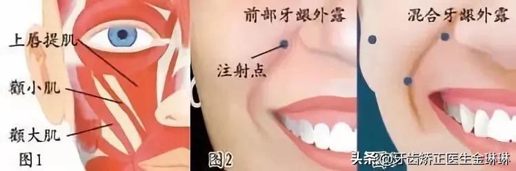 成年人露龈笑怎么矫正,如何矫正露龈笑嘴突
