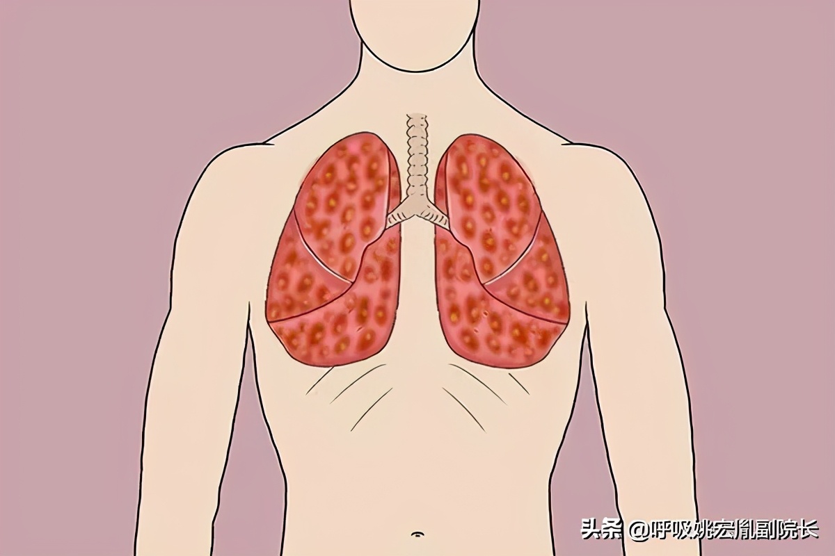 肺癌有没有得治,肺癌的治愈可能性有多大