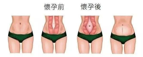 王妃产后被群嘲：肚子里还藏着一个？你所不知道的生育后遗症多可怕