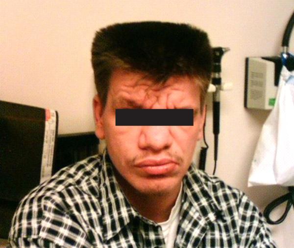 一种罕见病常跟儿童湿疹混淆，它是什么病呢？