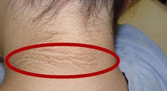 脖子旁边黑黑的洗不干净,为什么脖子上黑黑的洗不干净