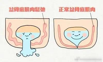 盆底康复，助力交往尴尬的女性