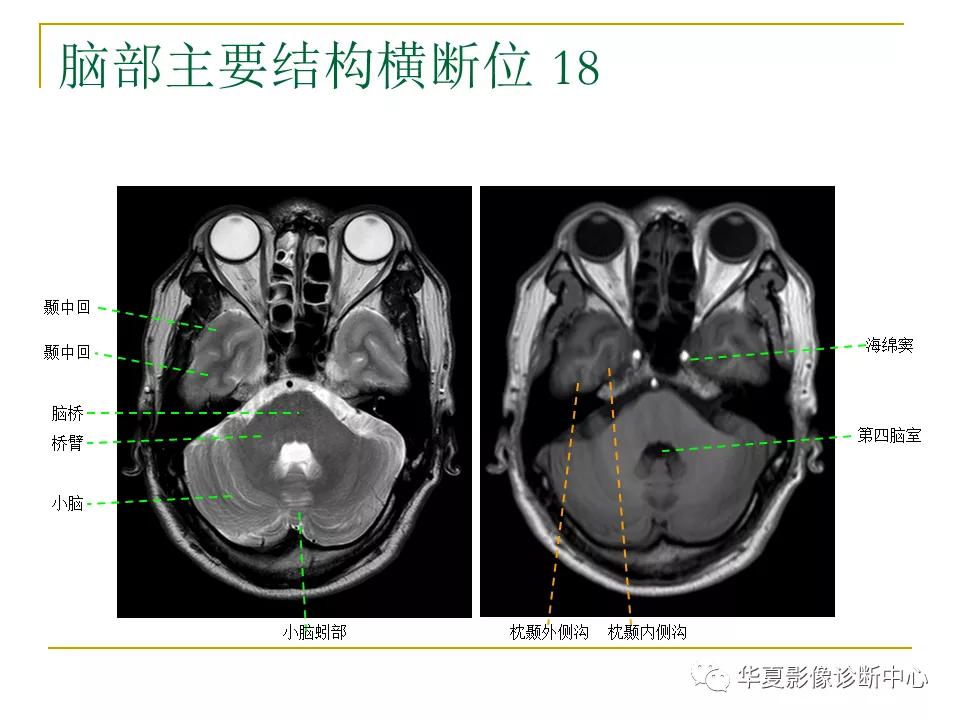 中国人脑立体定向mri应用解剖图谱,脑mri示意图