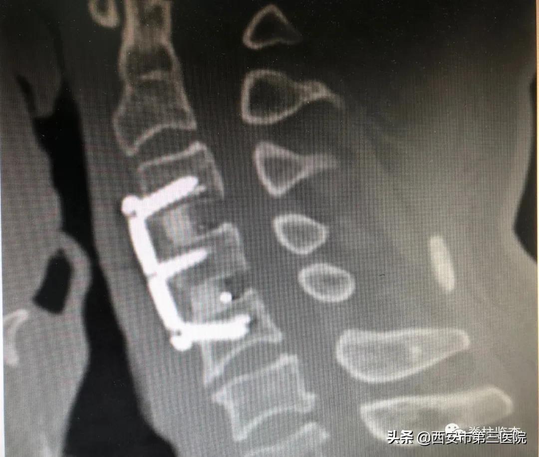 颈椎病减压手术安全么,手术脊髓减压