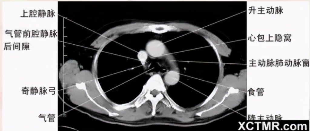 女性盆腔ct断层解剖结构图,女性盆腔脏器ct解剖