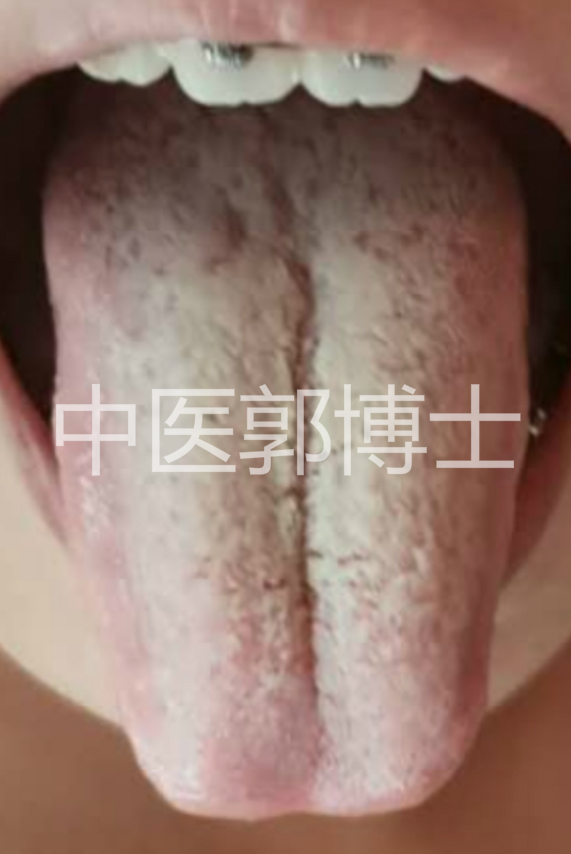 月经后一周喝中药又出血,例假淋漓不尽吃黄体酮还出血