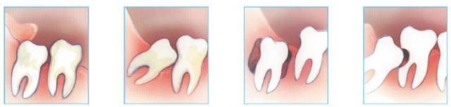 智齿向脸颊方向长一定要拔吗,40岁智齿横着长一定要拔吗