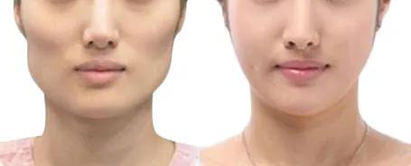 高颧骨脸型怎么变好看,脸型凹陷颧骨突出怎么矫正